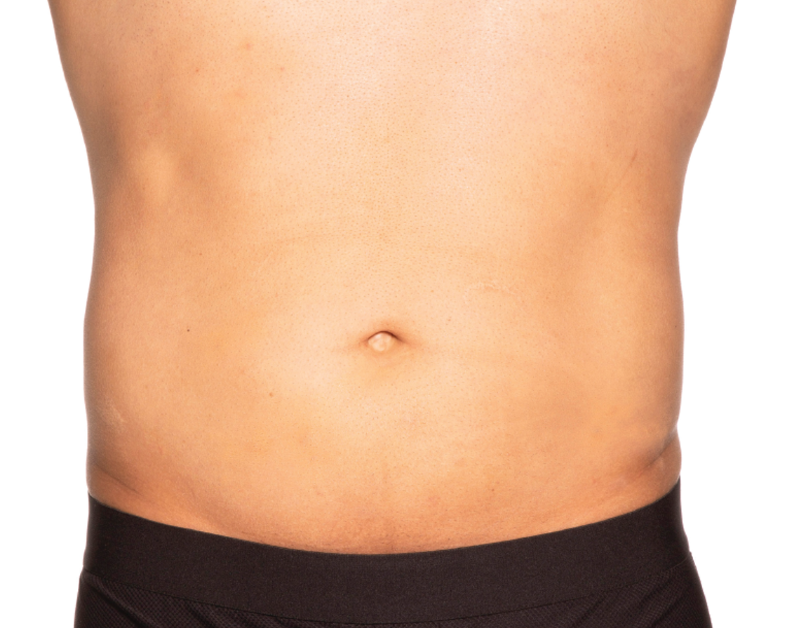 After treatment view of the abdomen & flanks