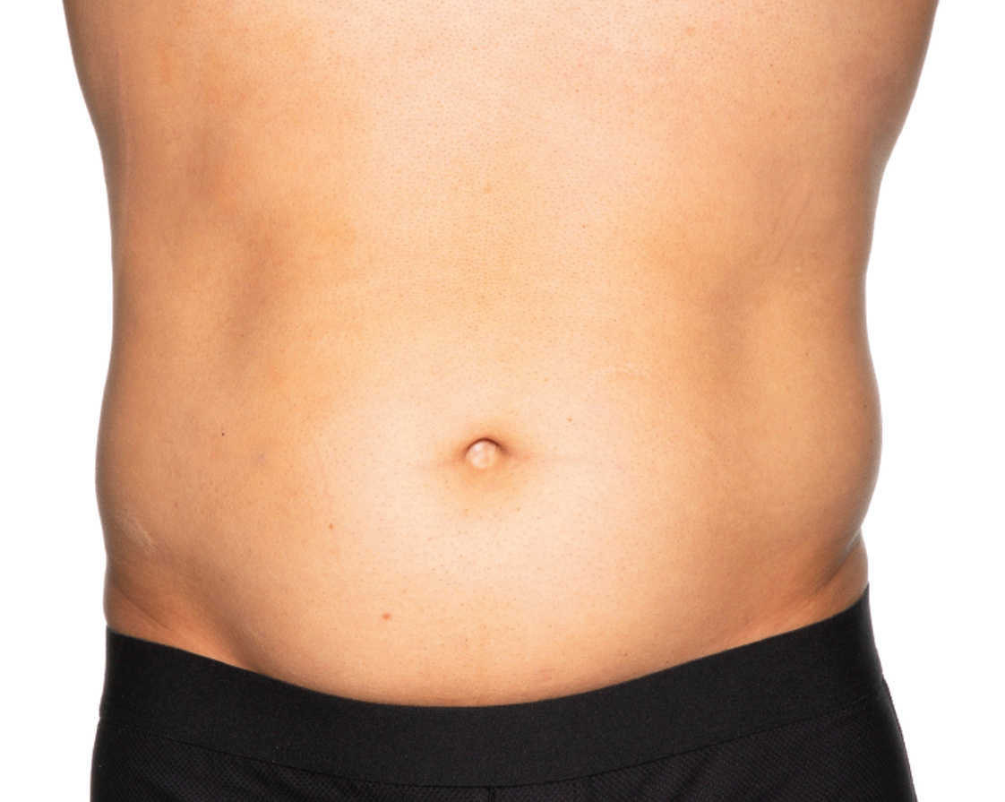 Before treatment view of the abdomen & flanks