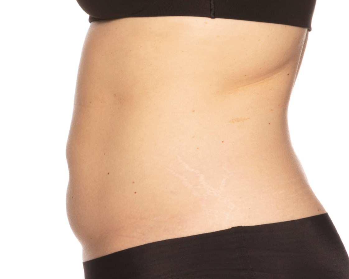 After treatment view of the abdomen & flanks