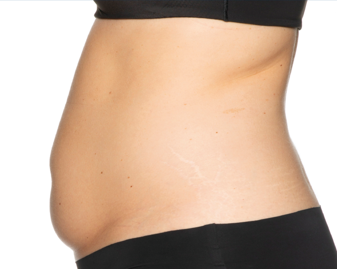 Before treatment view of the abdomen & flanks