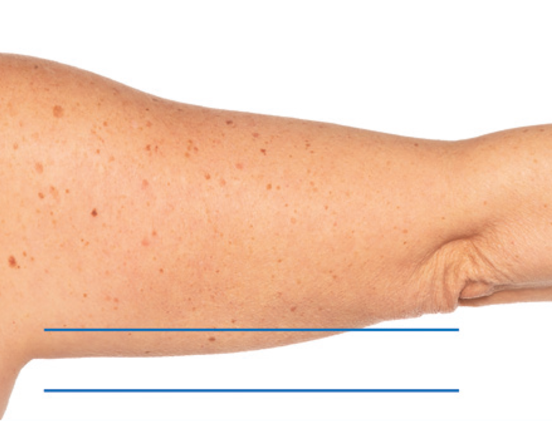 After treatment view of the arms