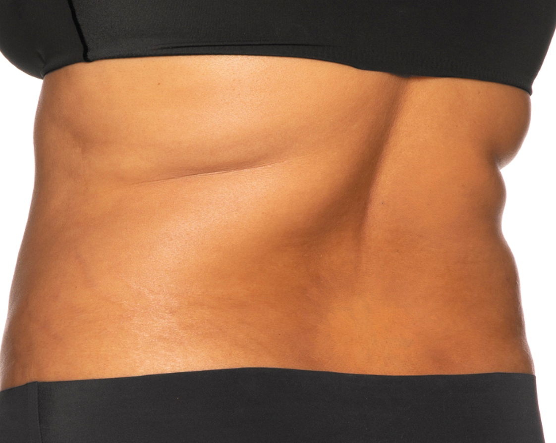 After treatment view of the bra area