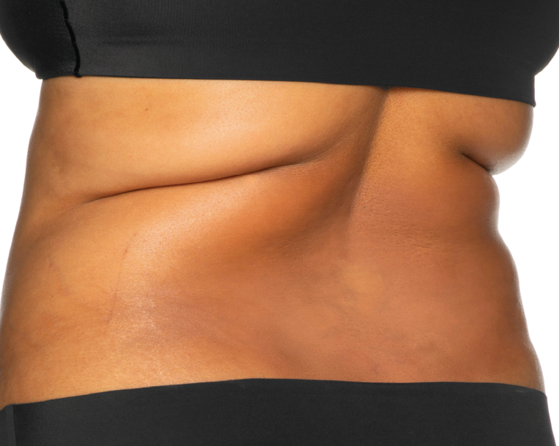 Before treatment view of the bra area