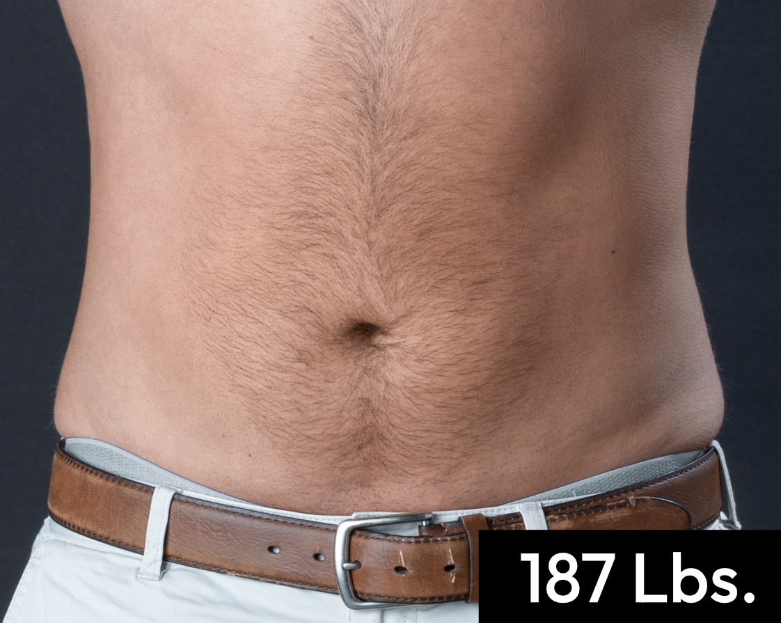 After treatment view of the abdomen & flanks