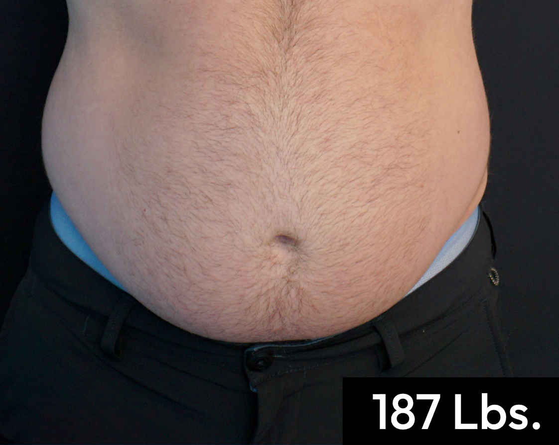 Before treatment view of the abdomen & flanks