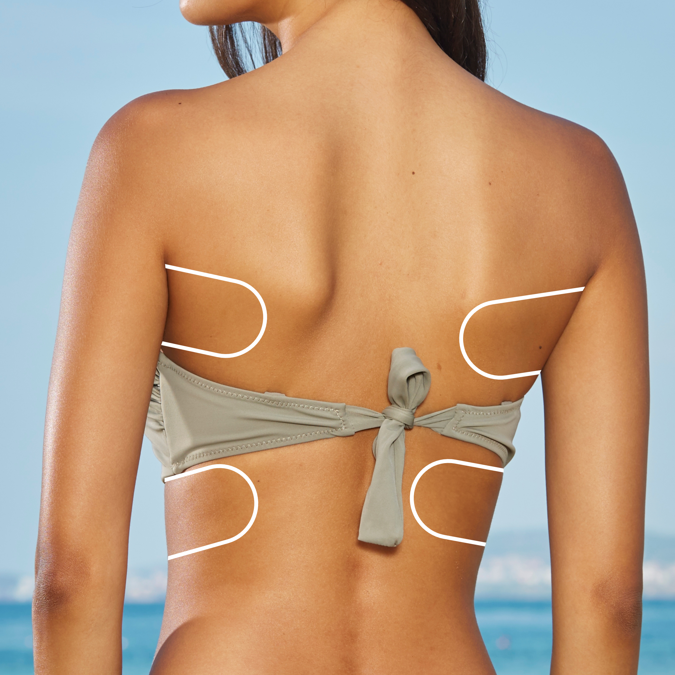 Illustration highlighting back and bra-line treatment areas